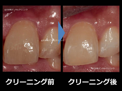 歯を白くするクリーニングの実例