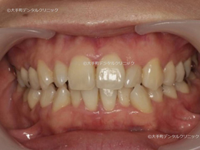 東京でマウスピース矯正おすすめの歯科での治療前の状態2