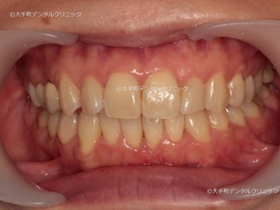 東京でマウスピース矯正おすすめの歯科での治療後の状態2