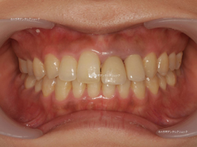 審美歯科 | 矯正治療とホワイトニングを併用した治療例の治療前