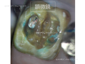 東京で根管治療おすすめの歯医者の治療