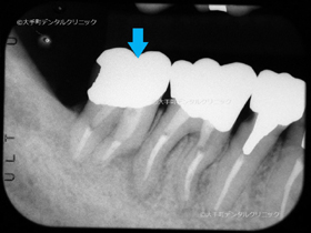 東京で根管治療が上手い歯医者の治療例の治療後