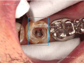 下の奥歯の根管口明示時の画像
