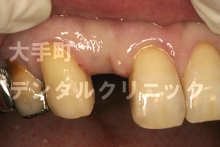 前歯インプラントの例（治療前）