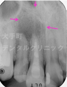 東京都千代田区大手町の歯科、根の治療（前歯）治療後１