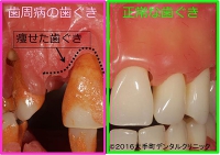 歯周病の歯ぐきと健康な歯ぐきの違いと症状