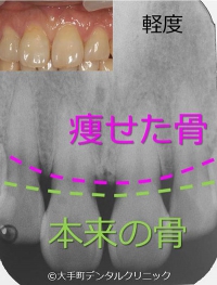 歯周病軽度の写真とレントゲンと症状