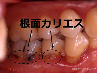 根面カリエス（歯の根の虫歯）