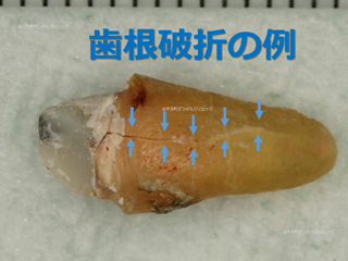 歯根破折(しこんはせつ)の例