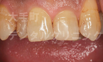 審美歯科、前歯の治療、術後